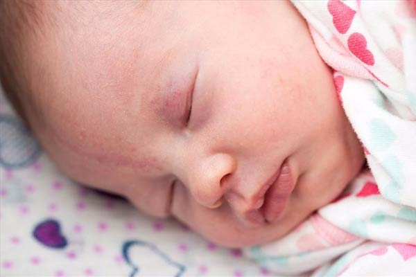 babies birthmarks
